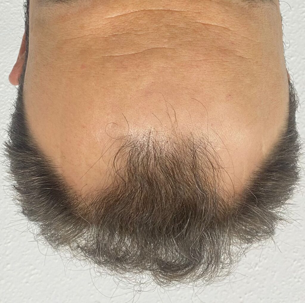 Antes