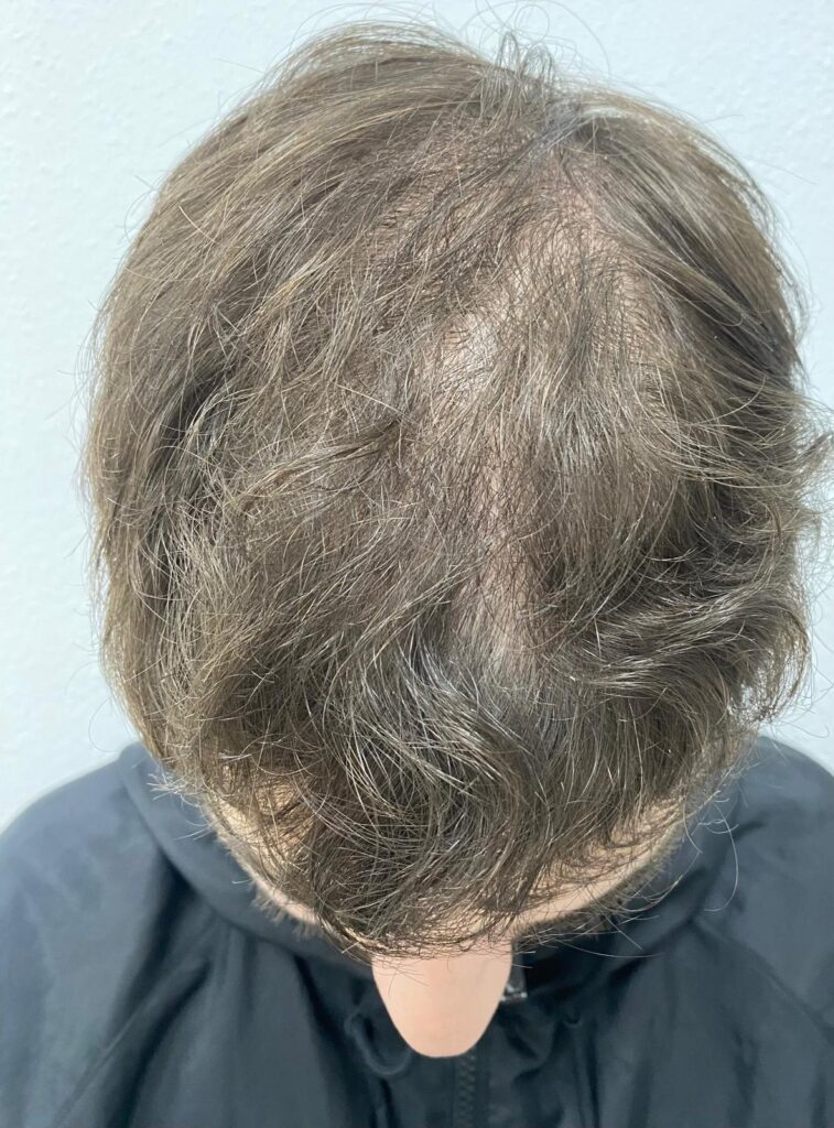 Antes