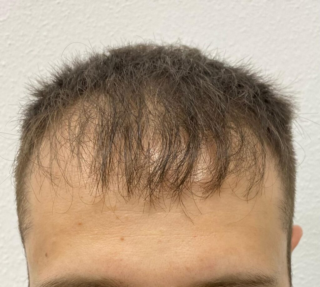 Antes