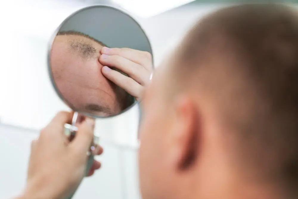 Alopecia androgénica