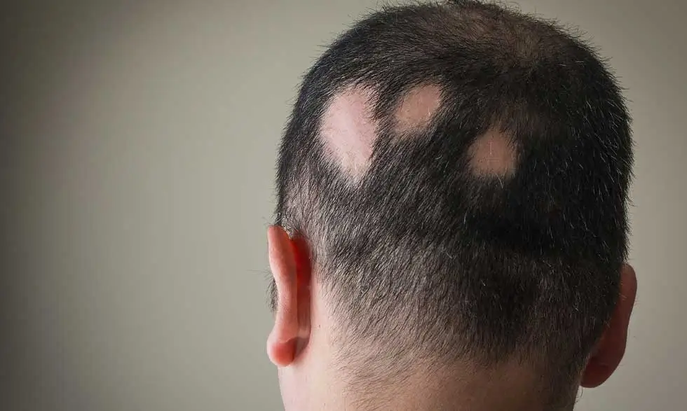 alopecia areata