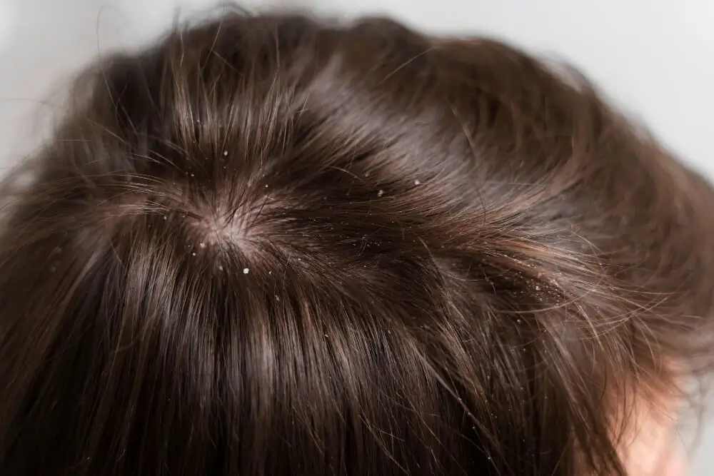 Alopecia seborréica
