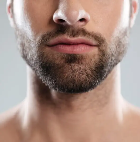 Trasplante de barba en Alcoy
